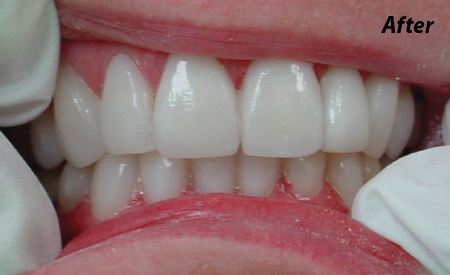 After-2 teeth