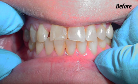 Before-1 teeth